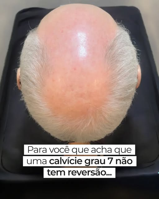 Calvície grau 7. Muita gente ouve isso e já pensa que não tem mais jeito. Esse paciente também pensa