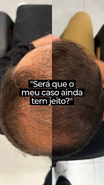 “Será que vai ficar natural?”
“Será que vou conseguir ter volume?”
“Será que o meu caso ainda tem je