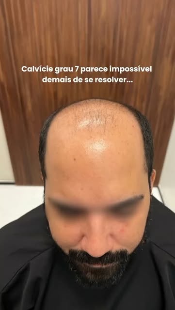 Esse é o tipo de caso que muitos profissionais não aceitam. A área doadora parece insuficiente, a ex