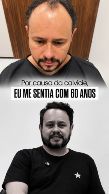"Me sentia com 60 anos."

Essa é a realidade de muitos homens que convivem com a calvície. Não é só 
