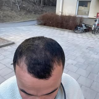 ئەنجامی چاندنەوەی قژ لە ریلیڤ تەنها دوای ١٠ رۆژ 
After 10 day only result of the hair transplant 
نت