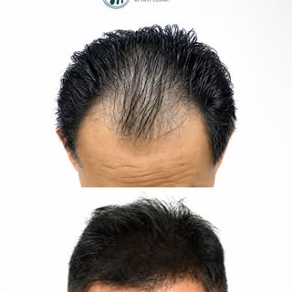 คืนความมั่นใจ ด้วย Personalized Hairline Design พร้อมเทคนิค Advanced Combination FUT + FUE เพื่อผลลั