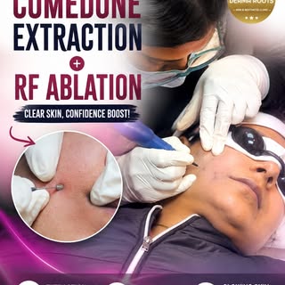 Comedone Extraction Procedure | Dermatologist Removes Blackheads

Struggling with stubborn blackhead