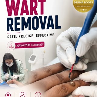 Wart Removal Treatment in Indirapuram | RF Ablation Procedure

Warts are common skin growths caused 