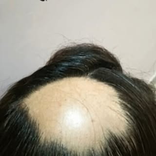 Hair fall ya baldness se pareshaan?
KB Hair Transplant Jaipur laa raha hai natural, permanent & pain