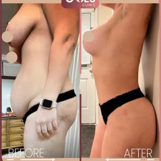 Mommy Makeover transformation at Cades Clinic 

This patient underwent Liposuction and Breast Augmen
