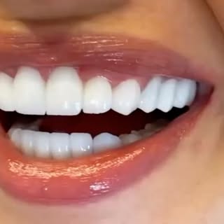 From an orthodontic perspective, this patient was a candidate for braces or clear aligners to correc