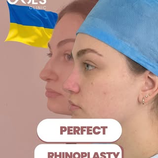 Rhinoplasty (Nose Job) Before & After | Septoplasty | Patient from Ukraine

Our patient from Ukraine