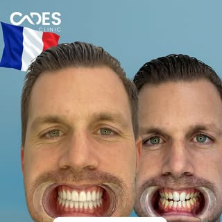 He never smiled with his teeth. Now he can’t stop. 😄
Nicolas came from France and left with a brand
