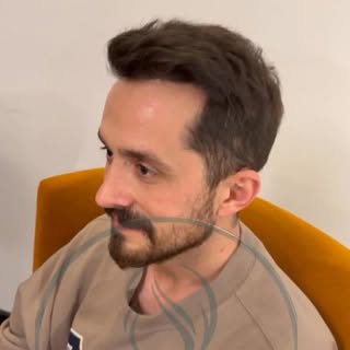 An example of a hair transplant procedure performed within the scope of our health tourism authoriza