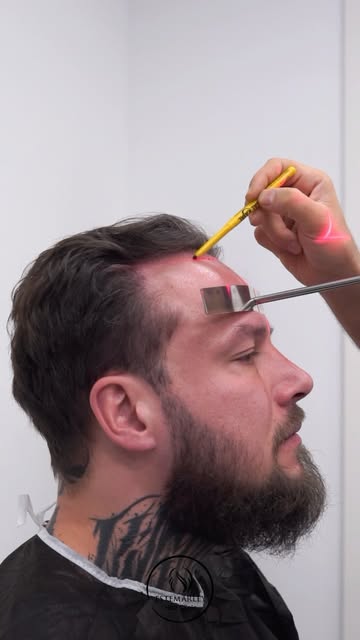 Unshaven hair transplantation 😎

An example of a hair transplant procedure performed within the sco