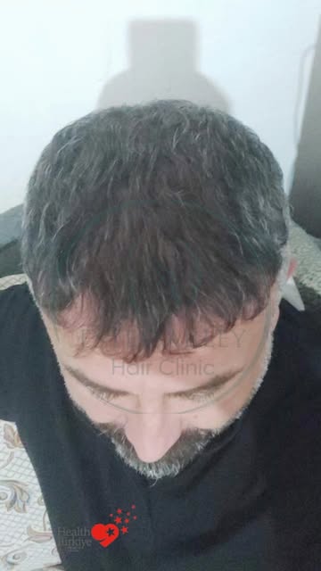 DHI hair Transplantation 

An example of a hair transplant procedure performed within the scope of o