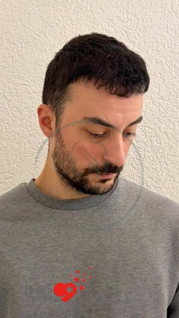 DHI hair transplantation 😎

An example of a hair transplant procedure performed within the scope of