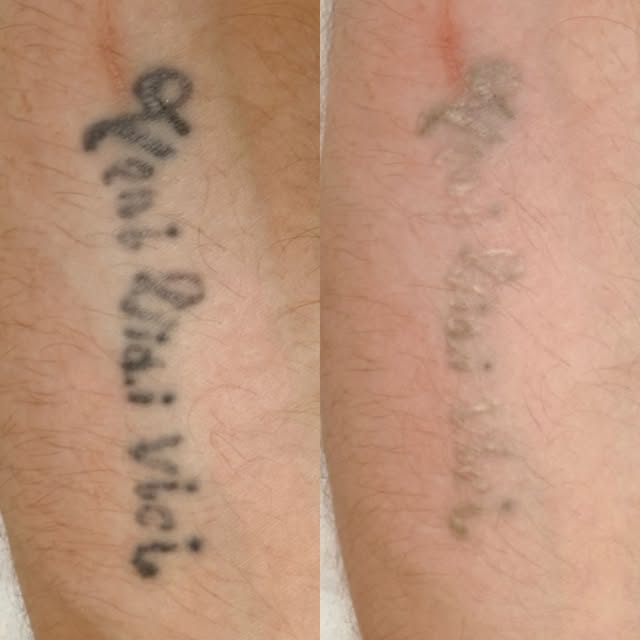 Picosecond laser tattoo removal 1 session straight after