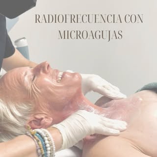 La radiofrecuencia con microagujas es uno de los tratamientos más avanzados en dermatología estética