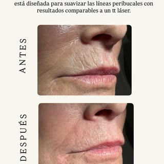 Se trata de una técnica personalizada con materiales de relleno. Y es que está diseñada para suaviza