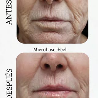 El MicroLaserPeel realiza una ablación precisa de la capa más superficial de la epidermis. Al retira