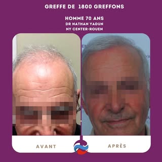🧑‍🦳➡️🧑‍🦰 Greffe de cheveux à 70 ans 

Greffe capillaire FUE au stylo implanteur !

📍 NY Center 