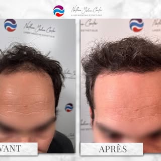Greffe de cheveux - un résultat naturel, pensé sur-mesure :
✔️ Ligne frontale harmonieuse
✔️ Densité