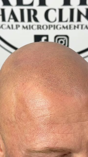3 YEARS HEALED 🔥

This is what quality SMP should look like years later — soft, natural and still b