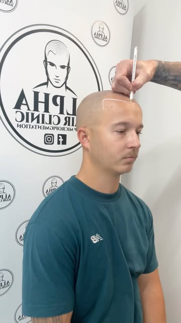 Hairlines are one of the most important parts of SMP — get it wrong and the whole treatment looks wr