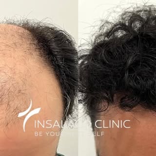 Risultato finale post 2 trapianti di capelli con tecnica FUE CIT di circa 6000 unità follicolari in 