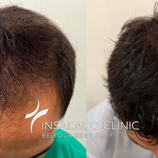 Un buon trapianto di capelli non è il risultato di un singolo gesto, ma della somma di tanti piccoli