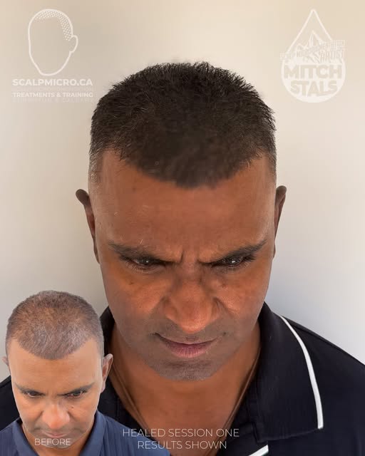 What do you think of the healed results?? 👀 Drop a 💪 below. And if you're dealing with thinning or