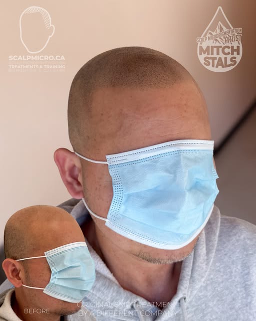 SMP Gone Wrong? Here's How I Fixed It — Session 1 | Edmonton #smpedmonton #smp #edmonton #hairlossta