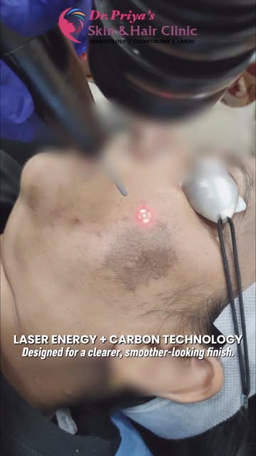 ✨ Clearer Skin Starts with the Right Technology!

Laser Energy + Carbon Technology can help improve 