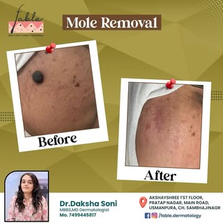 Before and after: A subtle transformation that makes a world of difference. Safe. Scar-minimizing. D