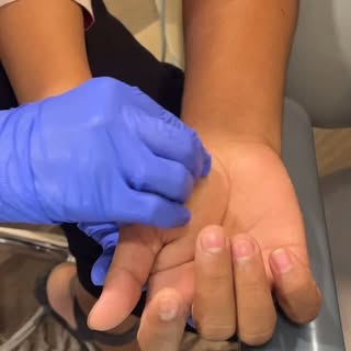 Wart is a viral infection which can be persistent and cosmetically distressing. With Radiofrequency 