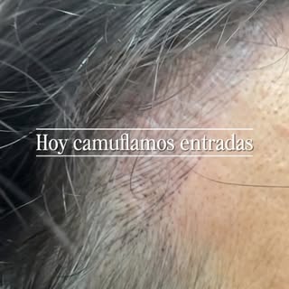 “Solo eran unas entradas...”
Eso fue lo primero que nos dijo nuestra clienta.
No tenía una alopecia 