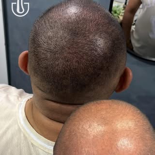 🔱Método BK - Fios Realistas 

🚨A micropigmentação capilar é uma técnica inovadora que utiliza pigm