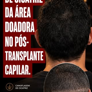 Camuflagem de Cicatriz Pós-Transplante Capilar ✨

Nem sempre o transplante capilar deixa apenas resu