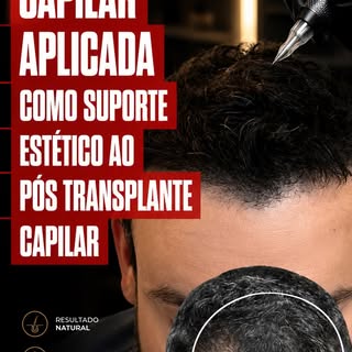 Camuflagem de Cicatriz Pós-Transplante Capilar ✨

Nem sempre o transplante capilar deixa apenas resu