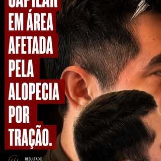 A alopecia por tração acontece devido à tensão excessiva e repetitiva nos fios ao longo do tempo. Pe