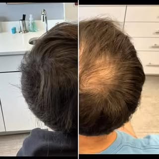 6-month hair transformation ✨

Consistency makes all the difference.
This patient came to Dr. Yesul 