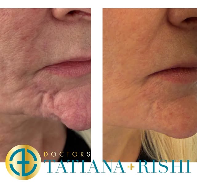 Treating significant scarring around the chin - with a fantastic outcome 👏

More ⬇️

This patient d