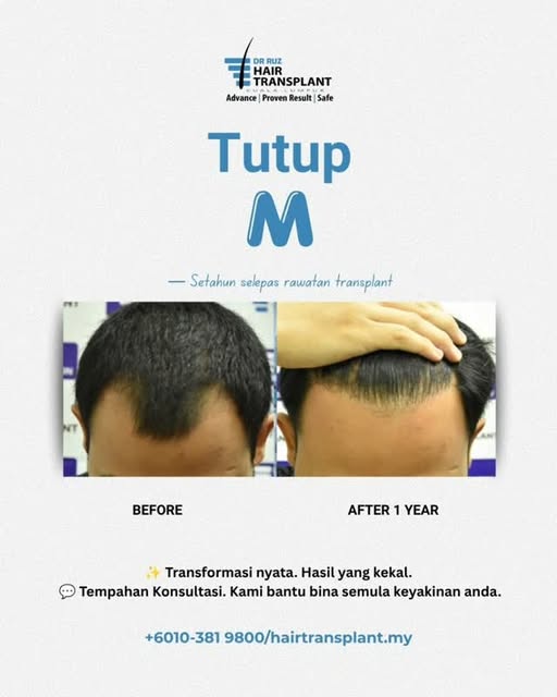 What if your hairline could change the way you see yourself?
Bukan tentang nak nampak sempurna.
Kada