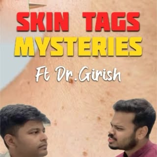 What are skin tags? Why this weird looking painless skin arises?

Dr. Girishkumar is out here to spe
