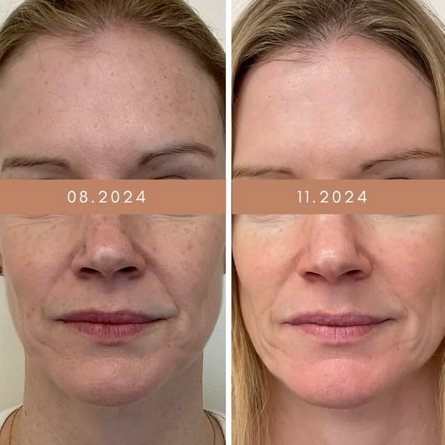 We 💙 the Obagi Kit! And for good reason. These dramatic results are the product of the Obagi Nu-Der