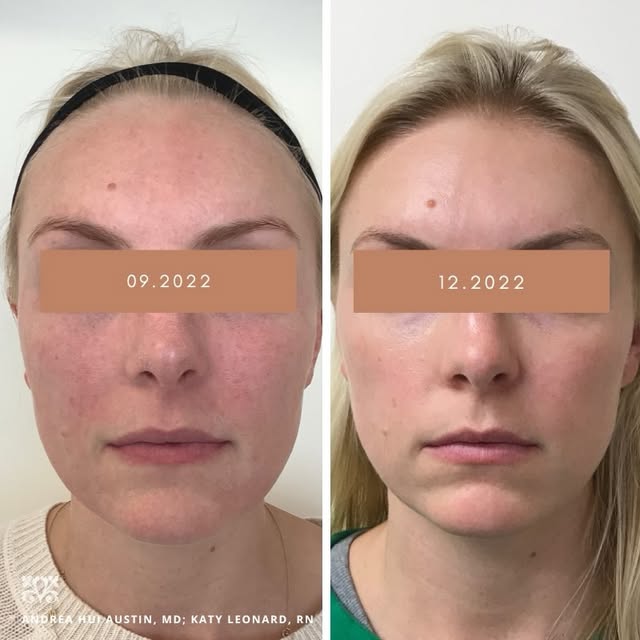 The BACD Signature Photofacial utalizes a unique combonation of 3 different lasers to correct brown 