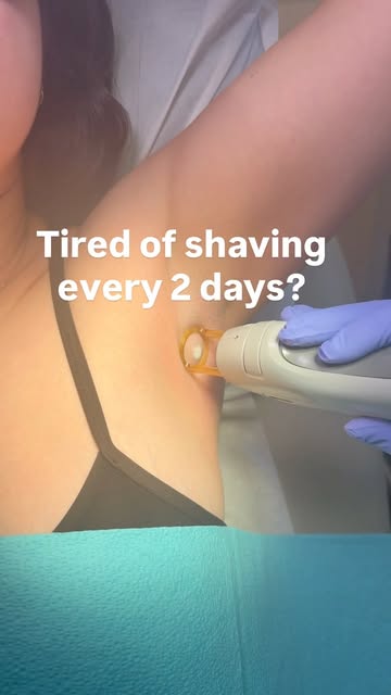 Laser hair removal targets the follicle at the root, disrupting future growth rather than just cutti