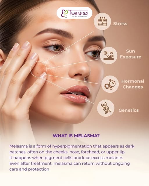 What is Melasma? ✨

Melasma is a common form of hyperpigmentation that causes dark patches, often ap