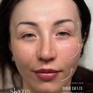 XERF PRINCESS ERA LOADING…

One side treated with XERF. One side untreated.

Look closely 👀

Brow +