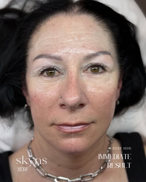 THE XERF HALF-FACE 🙌🏻

One side treated. One side waiting.

And this is immediate.

Look closely a