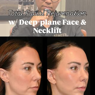 ✨ One month after comprehensive facial rejuvenation—and already a beautiful transformation.

This pa