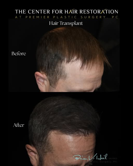 Hair restoration is about more than growing hair — it’s about restoring confidence.💇🏻🙌🏽

At Prem