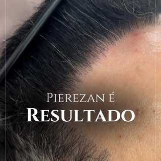 Pierezan é resultado: confira a naturalidade de nossas hairlines!
.
Densidade e naturalidade são as 